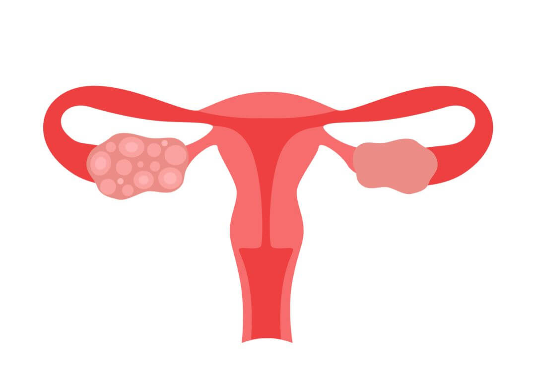 Syndrom polycystických vaječníků (PCOS) - jedna z nejčastějších příčin ženské neplodnosti